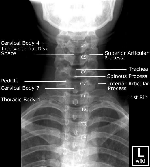 π-ο προβολή ΑΜΣΣ Intervertebral disk space : μεσοσπονδύλιο διάστημα Superior articular process : άνω αρθρική απόφυση Trachea : τραχεία Spinous process : ακανθώδης απόφυση