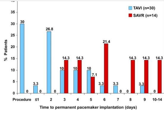 Need for Permanent Pacemaker as a Complication of TAVI and SAVR (similar ECG