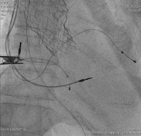 Acute MR after TAVR, CHB and