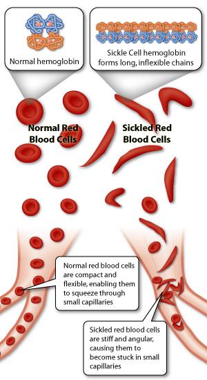 Simptomi anemije srpastih celic: -Premalo kisika v vranici, jetrih, ledvicah, pljučih, srcu, itd.