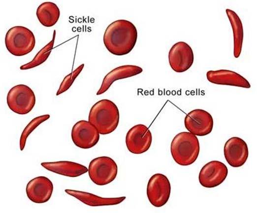 Nenormalna tvorba Hb - bolezni Cca 7% ljudi na svetu je prenašalcev za eno od nepravilnosti hemoglobina Znanih je ~ 1000 nenormalnih Hb Hemoglobinopatije nastanek nenormalnih globinskih verig (primer