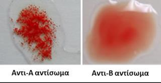 Τα αντισώματα του συστήματος ΑΒΟ βρίσκονται στο/στα: Α) Ερυθροκύτταρα Β) Λευκοκύτταρα Γ) Αιμοπετάλια Δ) Πλάσμα 30.