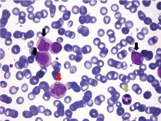 Κεφάλαιο 12 Παθήσεις των Λευκών Αιμοσφαιρίων 273 ζουν τις μυελοβλάστες, αποτελεί ένα χρήσιμο εργαλείο στη διαφορική διάγνωση μεταξύ μυελοβλαστικής και λεμφοβλαστικής λευχαιμίας.