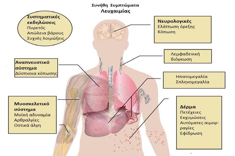 Η μελέτη του μυελού αναδεικνύει υπερκυτταρικότητα και παρουσία μονόμορφου πληθυσμού βλαστικών κυττάρων, μεταξύ των οποίων μπορεί να διακρίνονται ολιγάριθμα φυσιολογικά αιμοποιητικά κύτταρα.