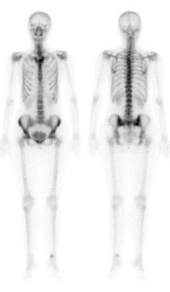 2b. Celotelová scintigrafia CELOTELOVÁ SCINTIGRAFIA SKELETU v prednej a