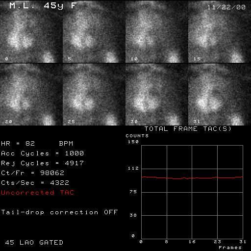 kamera EKG