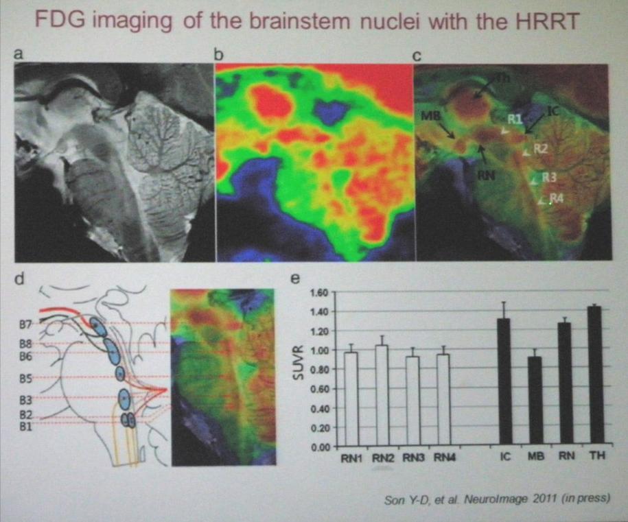 Nová PET-MRI technológia V