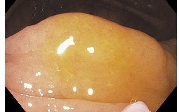 Serrated adenoma detection rate (SDR) Ποικίλλει μεταξύ των ενδοσκόπων Αδυναμία αναγνώρισης ενδοσκοπικά -επίπεδες βλάβες -παρόμοιο χρώμα με πέριξ βλεννογόνο -μη αποδοχή από ενδοσκόπους