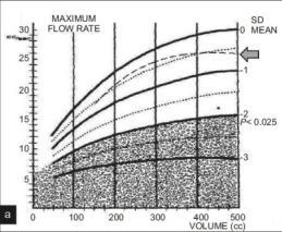 Qmax Qav Κορίτσια 19,33 ml/s 11,25 ml/s Αγόρια 16,9 ml/s 9,6 ml/s (Poulsen et al 1994) < 1