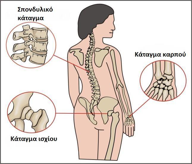 Κλινική εικόνα οστεοπόρωσης