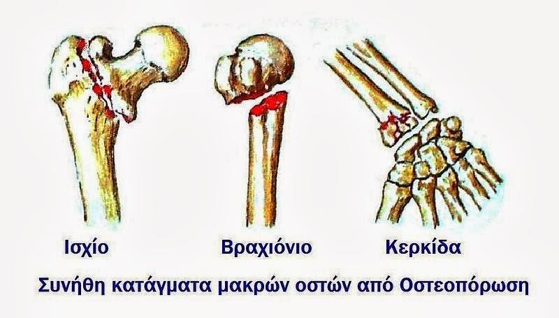 ΔΙΑΓΝΩΣΤΙΚΗ ΠΡΟΣΕΓΓΙΣΗ ΜΕΤΕΜΜΗΝΟΠΑΥΣΙΑΚΗΣ ΓΥΝΑΙΚΑΣ Οστεοπορωτικά κατάγματα Τα «οστεοπορωτικά» κατάγματα «τραυματικά» κατάγματα διαφοροποιούνται από τα γιατί