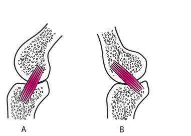 Ο οπίσθιος χιαστός σύνδεσμος τραυματίζεται όταν η κνήμη ωθείται προς τα πίσω ή όταν το γόνατο υπερεκτείνεται. Η λειτουργία των δύο πλάγιων συνδέσμων (Σχήμα 3.