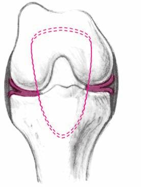 χιαστός σύνδεσμος Σχήμα 3.34 Δ. Οι μύες της άρθρωσης του γόνατος Οι εκτείνοντες του γόνατος Ο ορθός μηριαίος μυς εκφύεται από την πύελο και κάμπτει το ισχίο. Καταφύεται στην επιγονατίδα (Σχήμα 3.