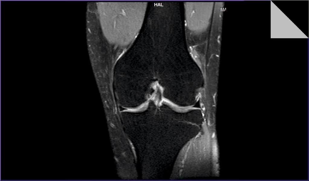 Πρόοψη Άρθρωσης από MRI