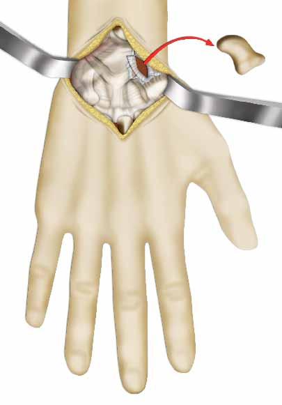 Η επέμβαση που σας προτείνουν Η βασική επέμβαση Ο χειρουργός αφαιρεί ένα έως τρία από τα μικρά οστά της πρώτης σειράς οστών του καρπού.