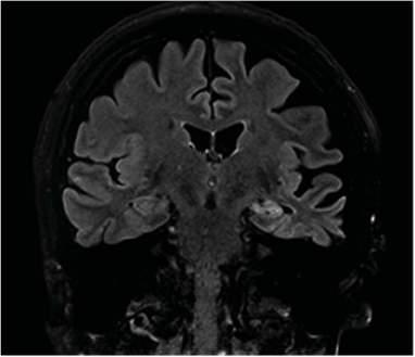 Slika 8. MR mozga (3 Tesla) u pacijentice s hipokampalnom sklerozom lijevo Slika 9. Funkcijski MR mozga (3 Tesla) u iste pacijentice s hipokampalnom sklerozom lijevo.