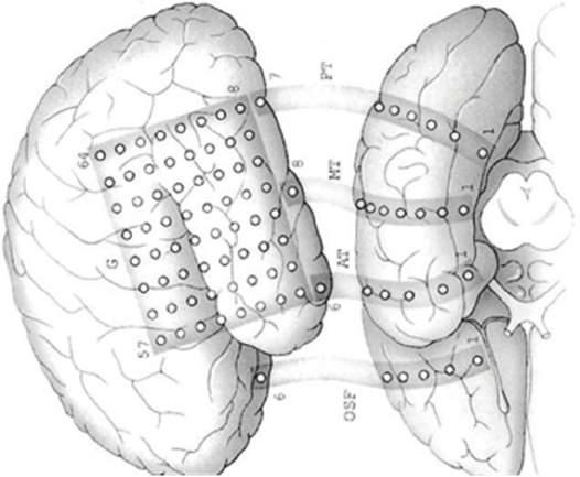 Slika 10. Subduralne grid (s lijeve strane) i strip elektrode (s desne strane).