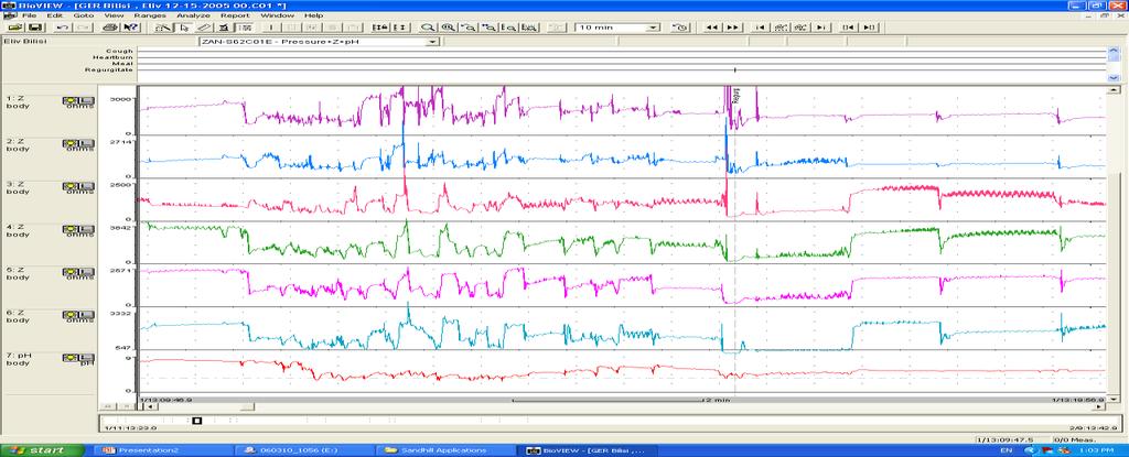 IMPEDANCE,