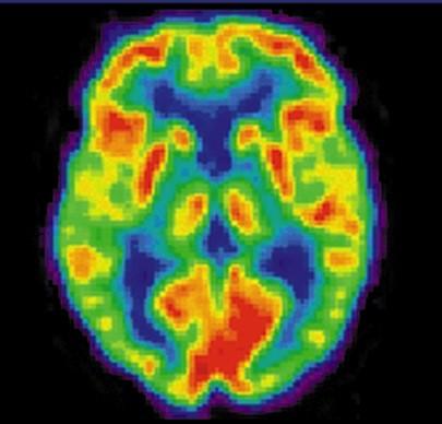 Emission Tomography) χρήσίμόπόίείό αντί-υόλή (πόζίτρόόνία = αντί ήλεκτρόόνία)