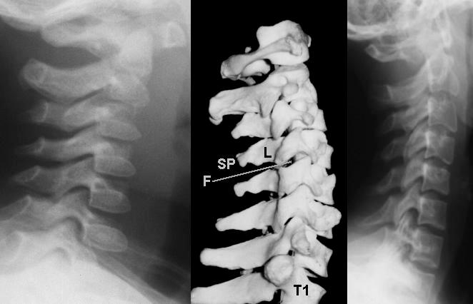 Χόνδρινες σπονδυλικές πλάκες (Vertebral end plates) (εικ.
