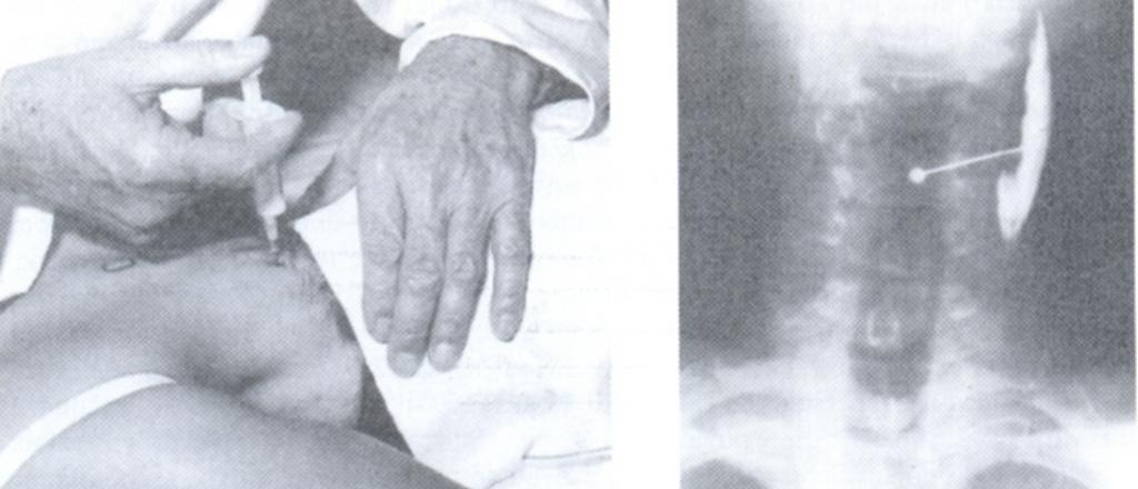 Εικ.297 Ε) Διήθηση «ευαίσθητων σημείων» (trigger points) στον αυχένα (εικ.