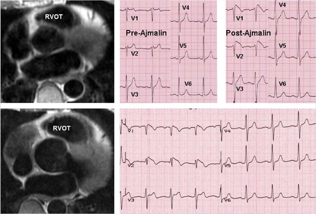 BrS ECG reveal significantly functional and morphological alterations in both