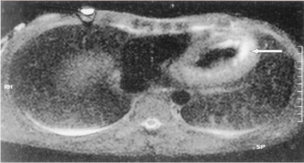 The Brugada syndrome is characterized by a distinct ECG pattern consisting of ST segment elevation in the right precordial leads and right bundle branch block, a propensity for life-threatening