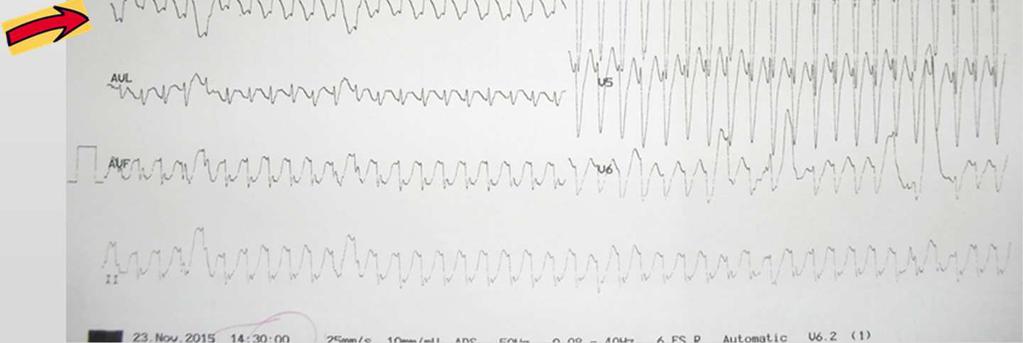 κυρίαρχα αρνητικό QRS Vi / Vt <1 ΚΡΙΤΗΡΙΟ Brugada