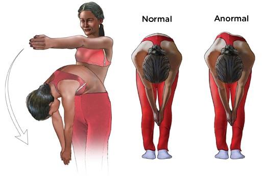 και Καραβίδας Νίκος, PT, MSc (W e in ste in e t a l 2 0 1 3 ) + Adam s test Schroth Scoliosis & Spine