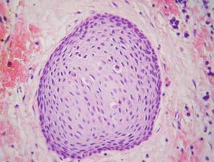 . Microscopic image of squamous odontogenic tumor -like proliferations within the wall of a radicular cyst, with localized intense inflammatory infiltration (hematoxylin-eosin, x200). Εικ. 2.