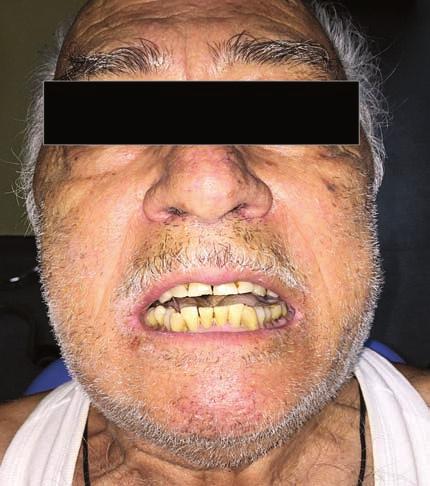Τρισμός οφειλόμενος σε κεφαλικό τέτανο/trismus caused by cephalic tetanus 23 Εικ. 2. Η πανοραμική ακτινογραφία χωρίς ιδιαίτερα ευρήματα. Fig. 2. Panoramic radiograph without any particular findings.