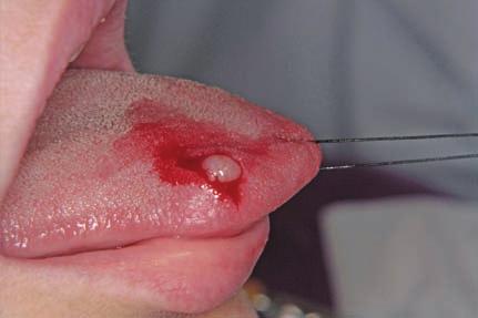 Μονήρες νευροΐνωμα γλώσσας/solitary lingual neurofibroma 29 Εικ. 2. Συγκράτηση της γλώσσας με νήμα περασμένο από την κορυφή της.