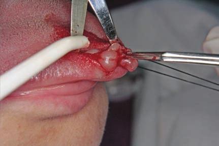 A linear incision was made into the underlying mucosa and the submucosal nodule was revealed. Εικ. 3. Αποκόλληση του ογκιδίου με τα αμβλέα σκέλη του ψαλιδιού. Fig. 3. The nodule was dissected from the surrounding tissues using the blunt edge of the scissors.