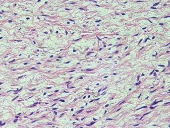 The histological examination revealed a fibromuscular tissue mass, which was multilobular, had clearly defined boarders and was surrounded by a thin capsule (haematoxylin-eosin stain, x20