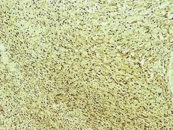 Μονήρες νευροΐνωμα γλώσσας/solitary lingual neurofibroma 3 Εικ. 7. Ανοσοϊστοχημική εξέταση του όγκου για S-00 πρωτεΐνη.