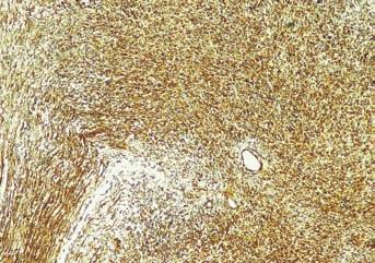 Positive immunostaining for S-00 protein, which is indicative of neural origin (S-00, x00 magnification) Εικ. 8. Ανοσοϊστοχημική εξέταση του όγκου για βιμεντίνη.