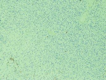 Positive immunostaining for vimentin, which is indicative of mesenchymal origin (vimentin, x00 magnification) Εικ. 9. Ανοσοΐστοχημική εξέταση του όγκου για ΕΜΑ.