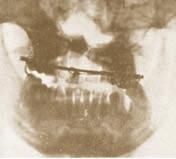 Radiografic depiction of a severely comminuted fracture of the body, the angle, and the ramus of the left mandible, with the fractured parts departing each other, and with many missile fragments