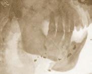 Radiograph proving the maximum depression of the fractured middle basic part of the body of the mandible, due to the action of the suprahyoid muscles, as well as the retention in normal occlusion of