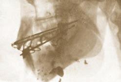 surface of the maxillary and mandibular teeth. Εικ. 21. Καταγματίας που φέρει περιδέσεις δοντιών, μαζί με παρεμβολή μεταλλικού τόξου, στο οποίο άγκιστρα στηρίζουν δακτυλίους διαγναθικών έλξεων. Fig.