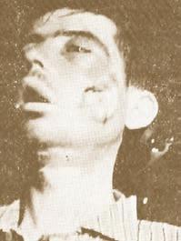 The protrusion of the left half of the upper lip is obvious, due to the destruction of the buccal branches of the facial nerve. Εικ. 28.