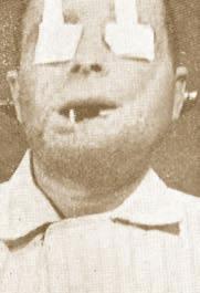 Fig. 29. Defect of the 2/3 of the central portion of the lower vermillion and of enough portion of the lower lip. Face covered by scarry remnants of traumatic surfaces.