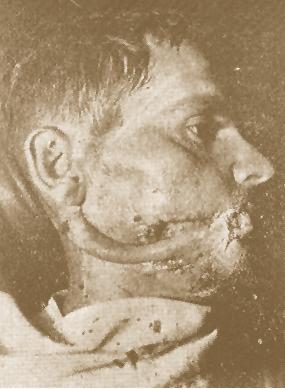 In the center of the traumatic surface the uncovered bone of the mandible is recognized. Εικ. 32 & 33.