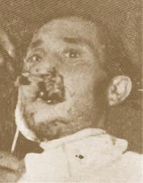 Horribly disfigured injured person with open wounds in the face and loss of soft tissues in the upper and lower lip, particularly in the left commissure. Εικ. 35.