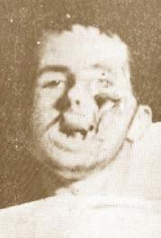 Horrible trench in the left area of the face, due to the passage of mortar missile fragments. Εικ. 38. Το αποτέλεσμα μετά την πρώτη επέμβαση για συμπλησίαση των τόσο αφεστώτων χειλέων του ορύγματος.