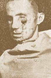 The result after the first operation for approximation of the so far apart edges of the trench. The depicted triangular gap in the left infraorbital region remained after the removal of the sutures.