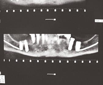 The implants contact the inferior alveolar nerves bilaterally. Στην ασθενή εξηγήθηκε ότι η αφαίρεση των εμφυτευμάτων δεν θα μπορούσε να εξασφαλίσει τη θεραπεία, παρά ενδεχομένως μια μικρή βελτίωση.