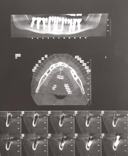 66 Γκουτζάνης Λ. και συν./goutzanis L. et al. Εικ. 4. CT Dentascan, κάτω γνάθου. Παρατηρούνται τα εμφυτεύματα να καταλαμβάνουν τον πόρο του κάτω φατνιακού νεύρου, δεξιά. Fig. 4. CT Dentascan of the mandible.