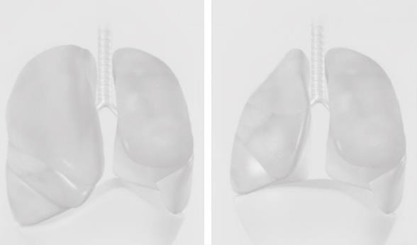 2nd one-day course in Interventional Pulmonology Endoscopy Lung Volume Reduction in the Management of