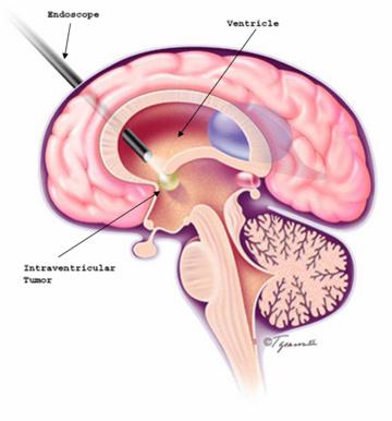 Θεραπευτική προσέγγιση Η 3η κοιλιοστομία, η οποία διενεργείται με ενδοσκόπιο, επιτρέπει την δημιουργία μιας οπής στο έδαφος της τρίτης κοιλίας, μέσω της οποίας το εγκεφαλονωτιαίο